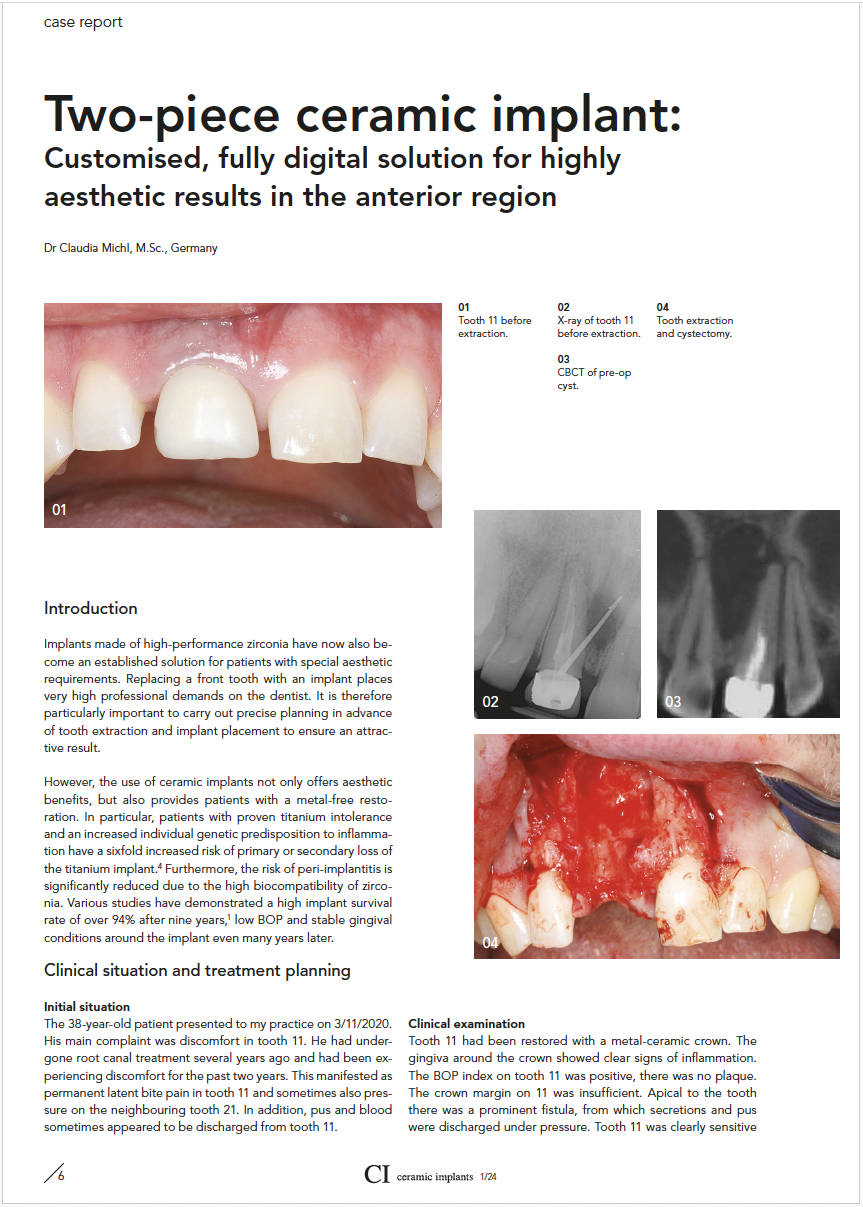 Zweiteilige Keramikimplantate: Individuelle volldigitale Lösung für hochästhetische Ergebnisse im Frontzahnbereich - Dr. Claudia Michl