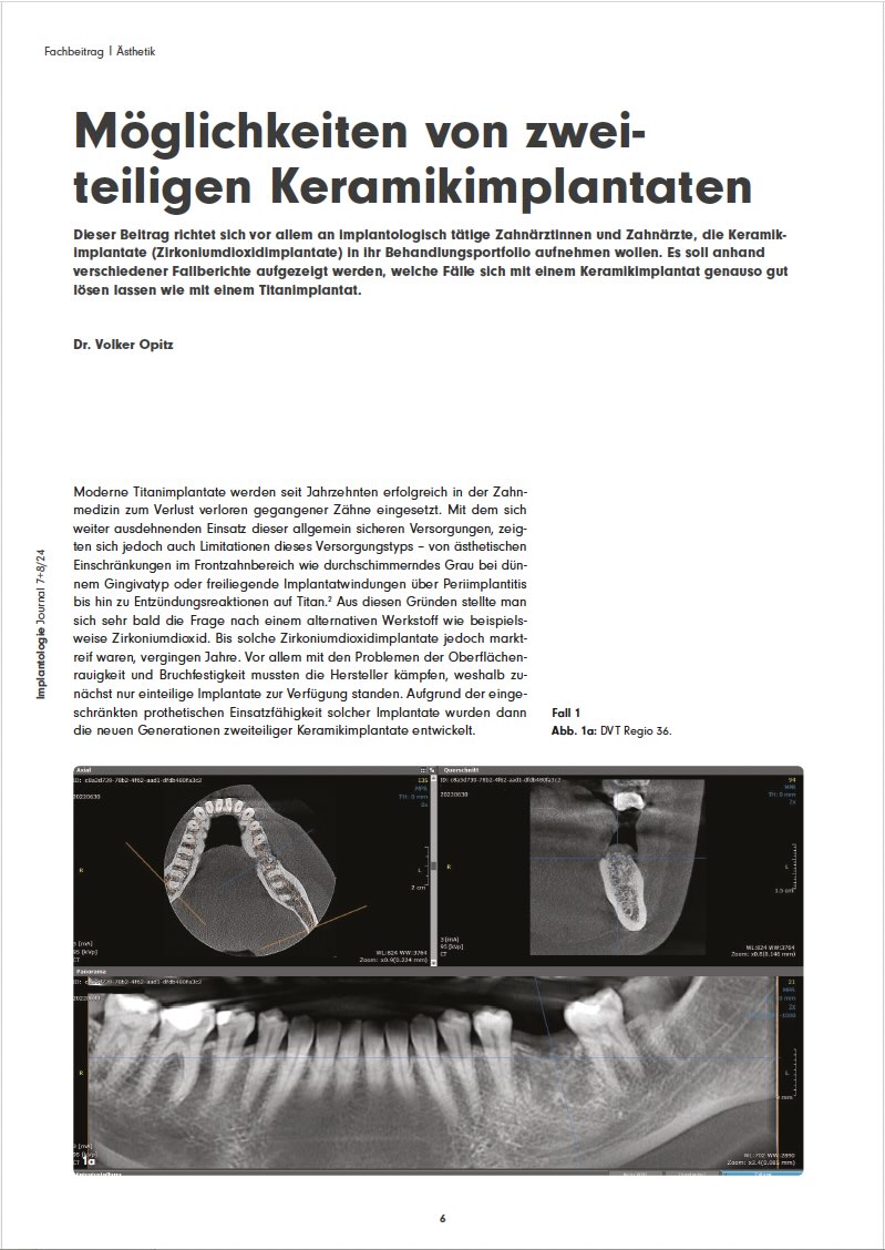 Möglichkeiten von zweiteiligen Keramikimplantaten – Dr. Volker Opitz