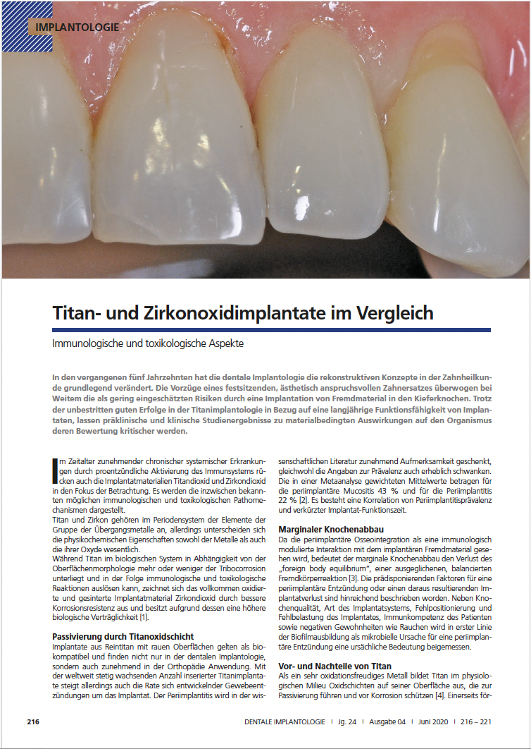 Titan- und Zirkonoxidimplantate im Vergleich: Immunologische und toxikologische Aspekte