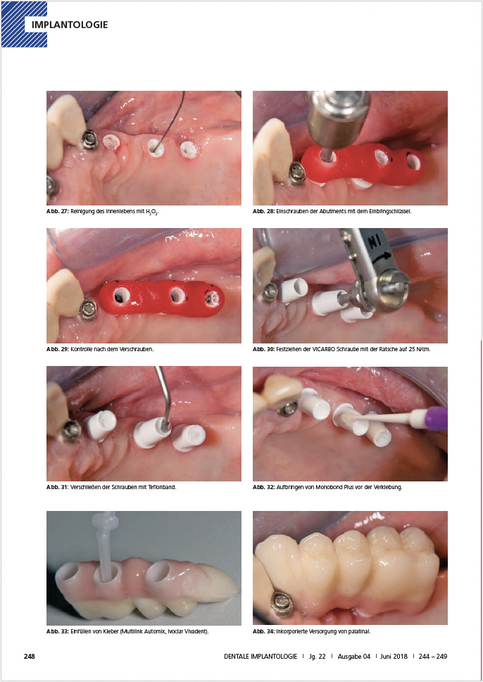 Brücke auf Keramikimplantaten im Seitenzahnbereich – Dr. Michael Leistner