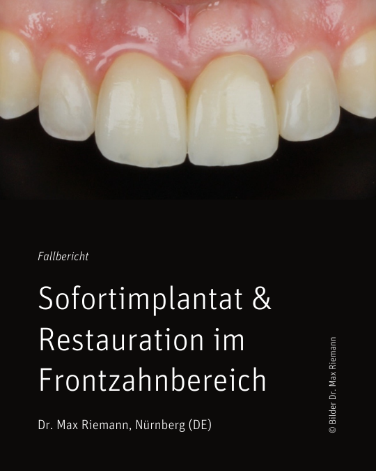 Sofortimplantat & Restauration im Frontzahnbereich – Dr. Max Riemann