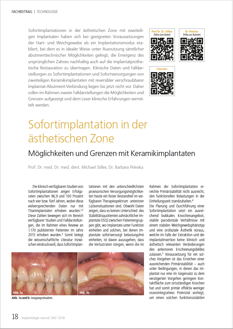 Sofortimplantation in der ästhetischen Zone: Möglichkeiten und Grenzen mit Keramikimplantaten