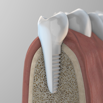 Impianti in zirconia