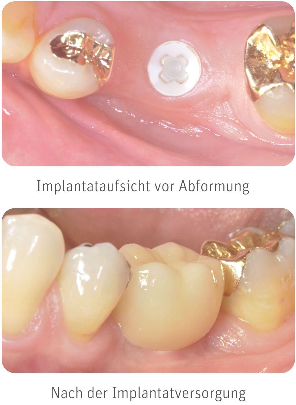 Implantat Erfahrungen