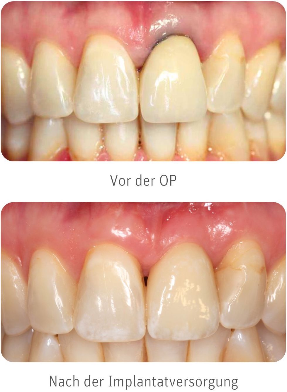 Zahnimplantat Erfahrungen