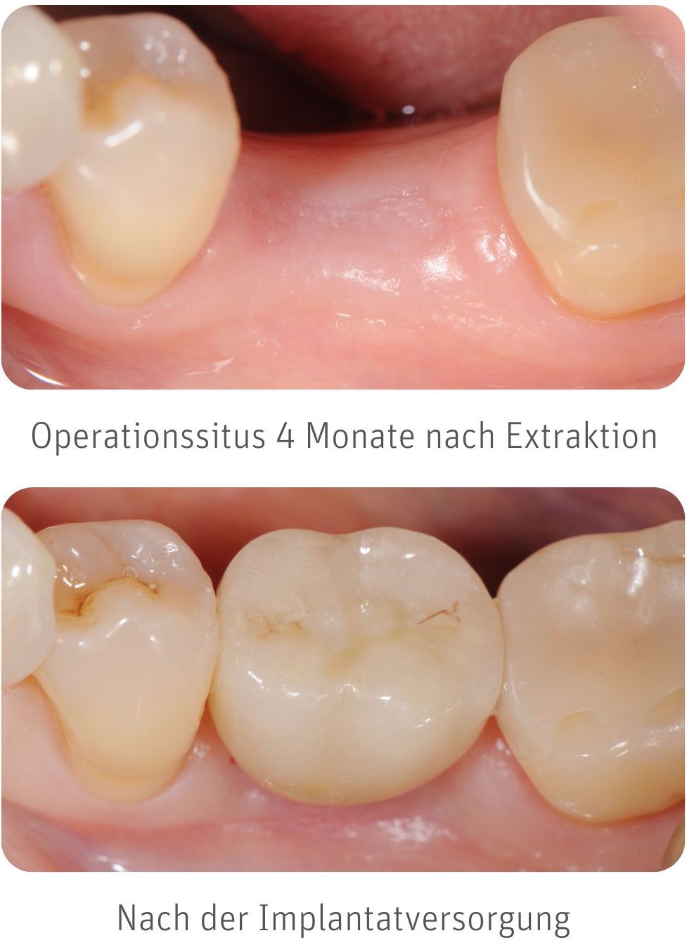 Zahnimplantat Erfahrungen